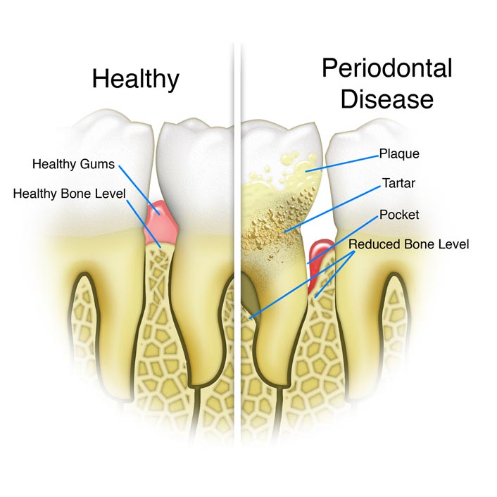 Periodontal Cleaning - Dental Services