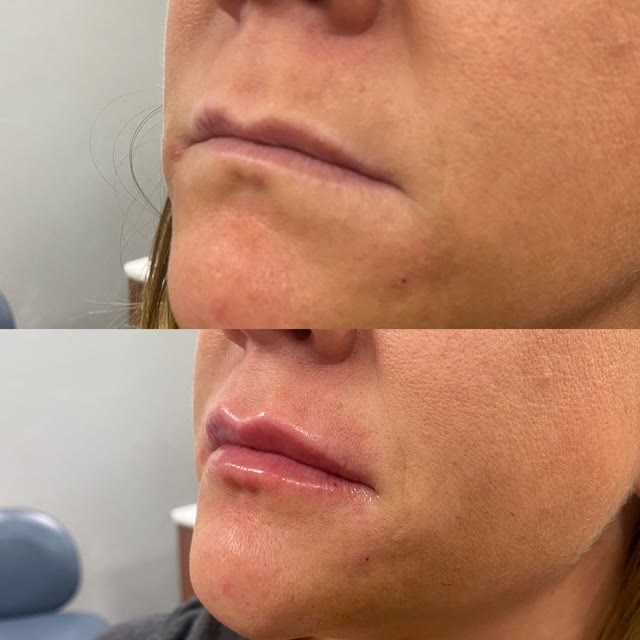 Before and after lip filler — lips appear fuller and more defined.