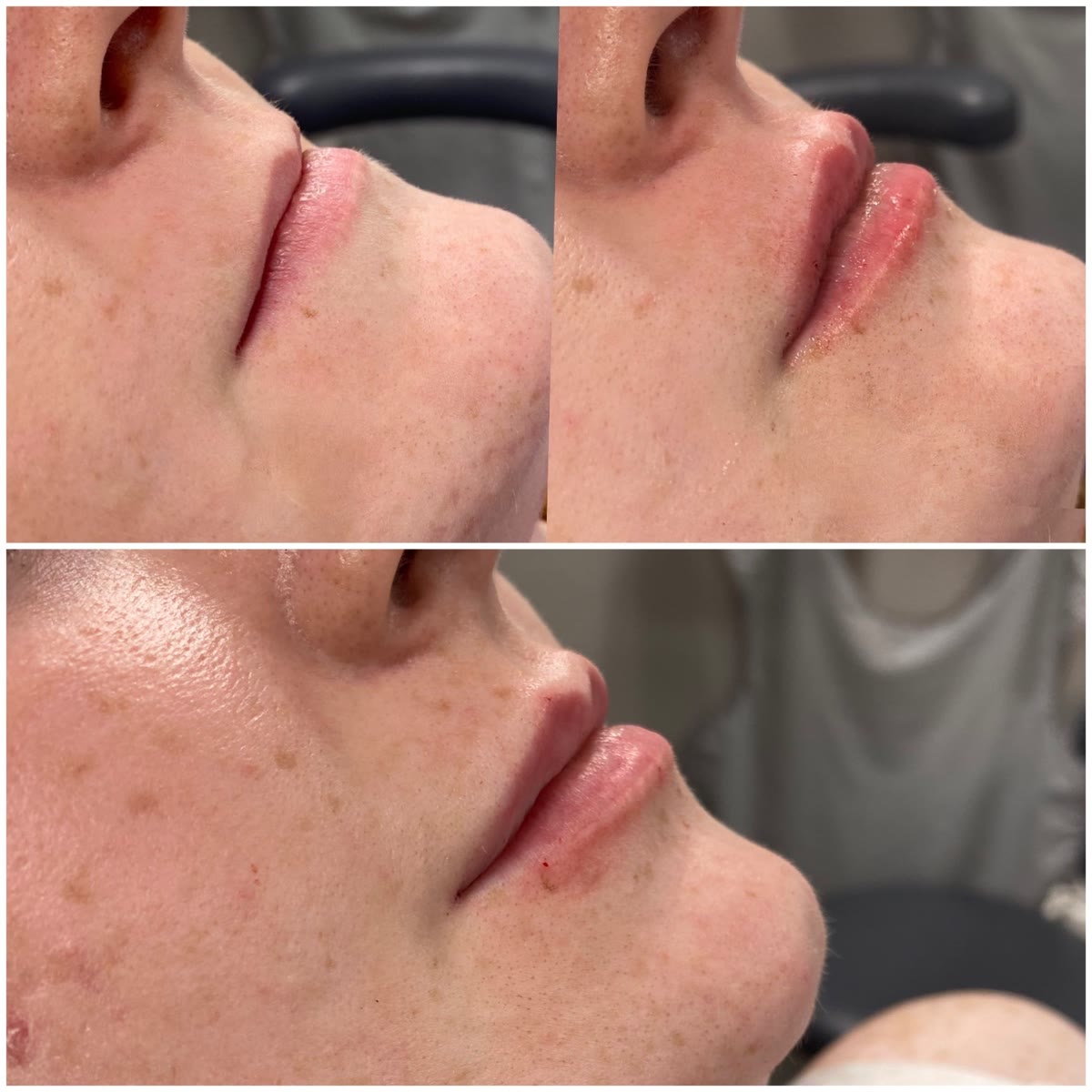 Lips before and after filler, shown from the front and in profile.