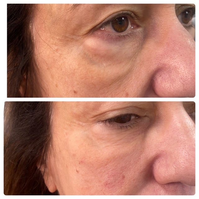 Before and after of the eye area, showing reduction of under-eye bags.