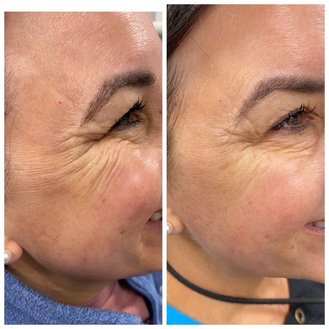 Comparison of the eye area — smoother skin after treatment.