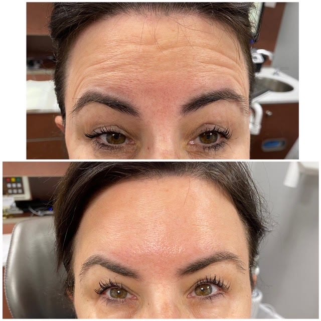 Forehead with wrinkles before treatment and smoother after treatment.