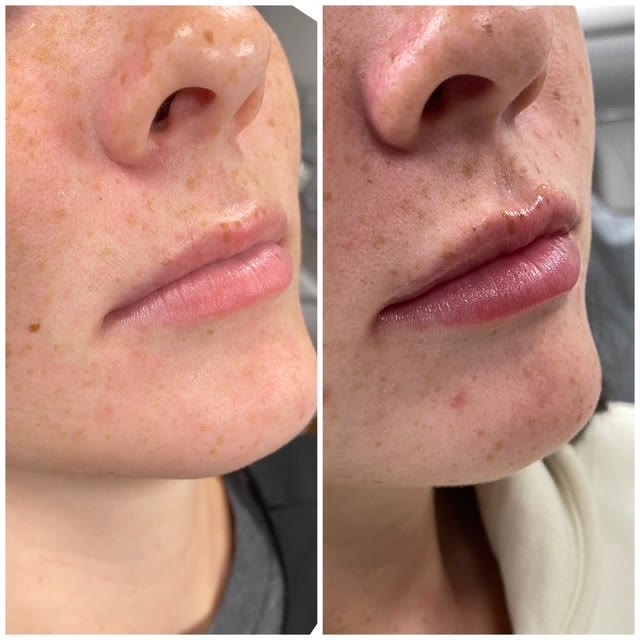 Lips before and after filler treatment — fuller in the after photo.