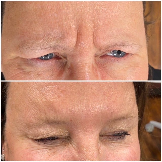 Before and after comparison of brow wrinkles, smoothed after treatment.