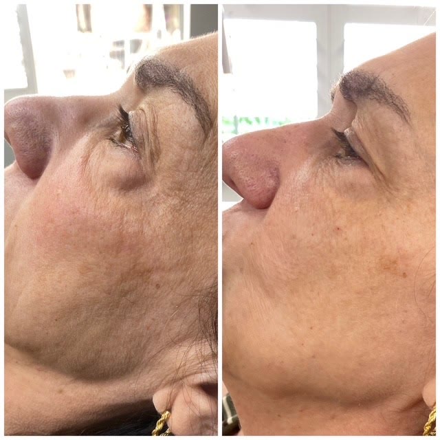 Side-by-side comparison of the face — fewer wrinkles after treatment.