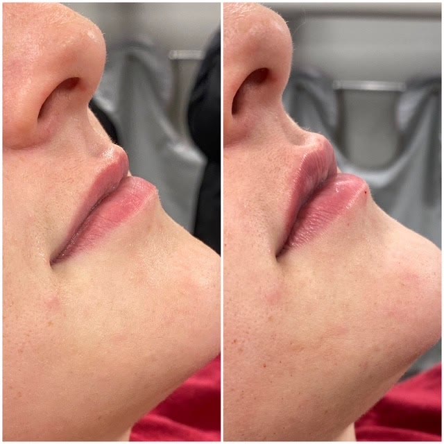 Side-by-side comparison of lips before and after filler.