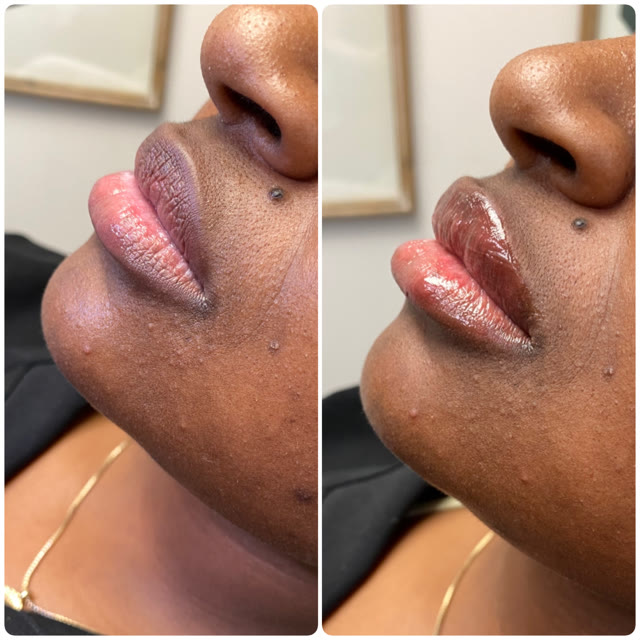 Lips before and after cosmetic treatment.