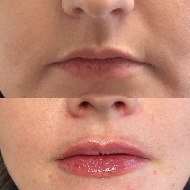 Before and after comparison of lip augmentation.