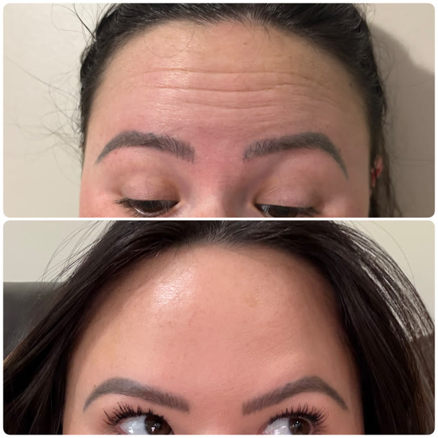 Forehead wrinkles before and after treatment, showing smoother skin in the after photo.