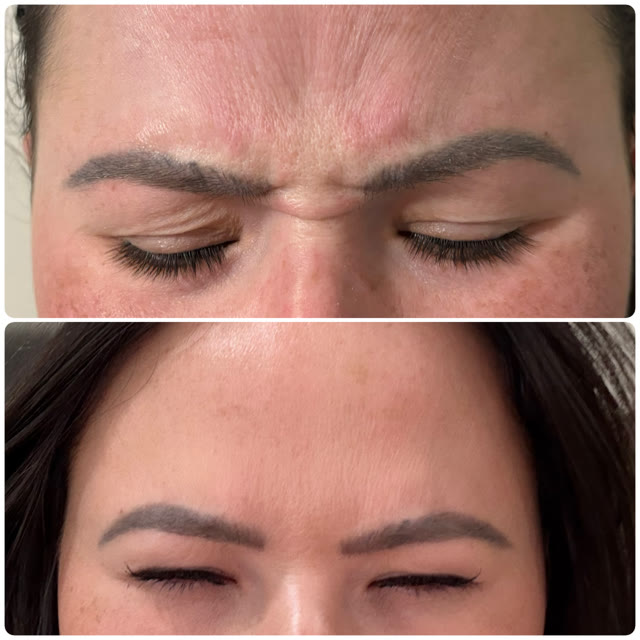 Before and after of forehead lines — a smoother, more relaxed expression after treatment.