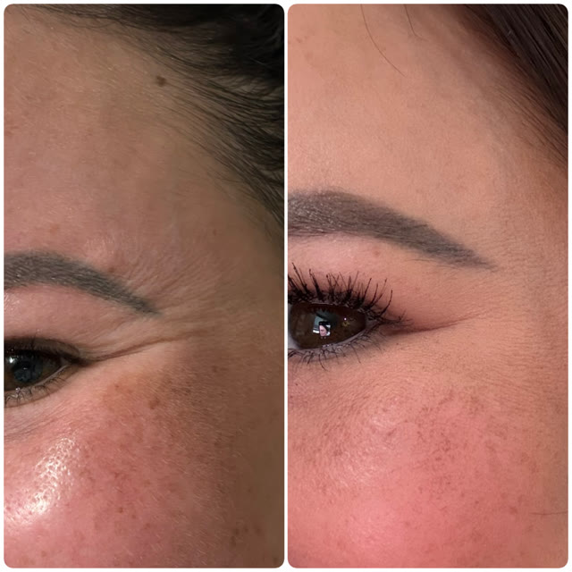 Before and after of the eye area, showing a reduction in wrinkles.