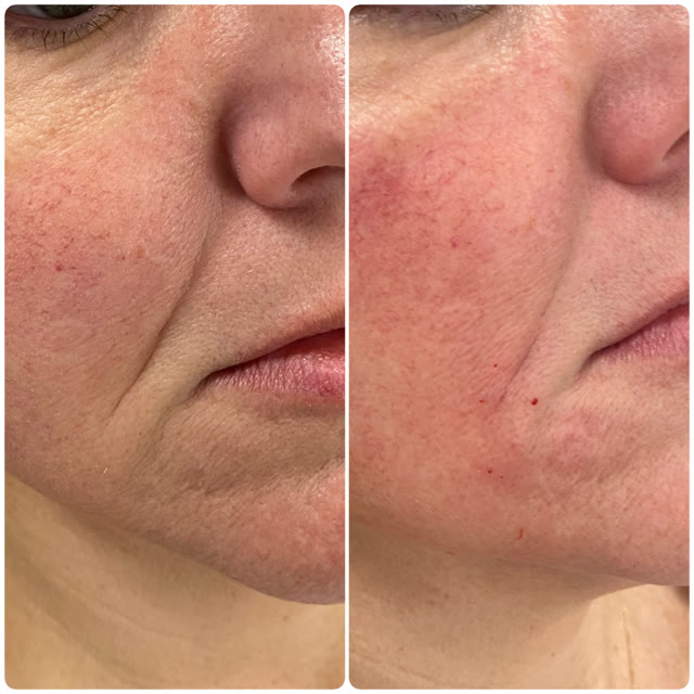 Before and after of the cheek and mouth area, showing reduced wrinkles and redness.