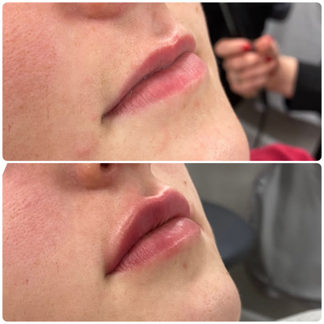 Before and after lip filler — the upper lip appears fuller in the after photo.