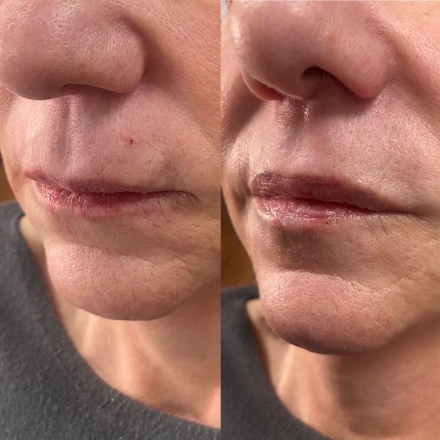 Before and after lip filler — the after photo shows fuller lips with fewer fine lines.