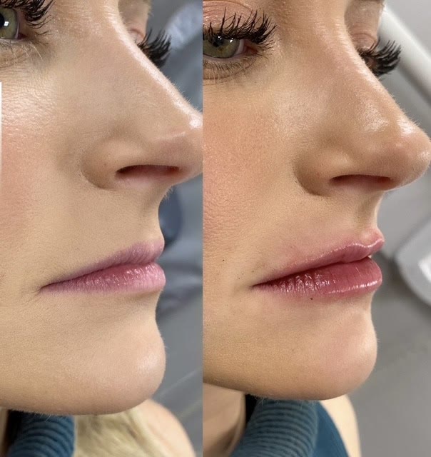 Lips before and after filler, shown in profile.