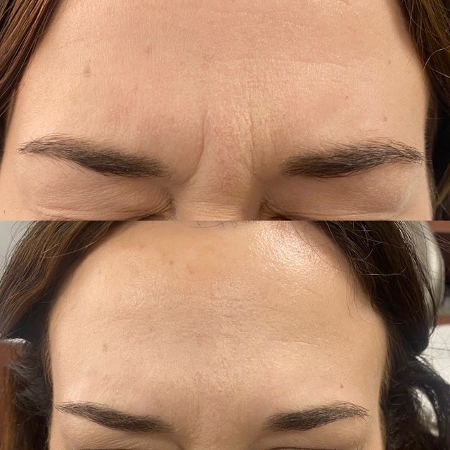 Forehead with wrinkles compared to a smoother forehead after treatment.