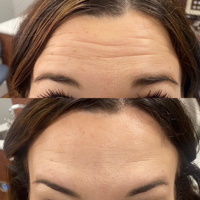 Forehead before and after treatment, showing fewer wrinkles.