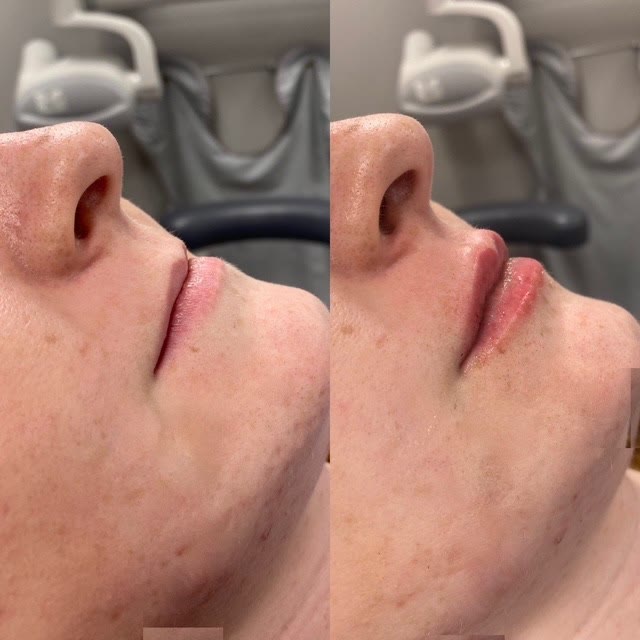 Profile before and after lip filler treatment.