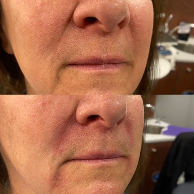 Before and after around the mouth and nose — wrinkles are less visible after treatment.