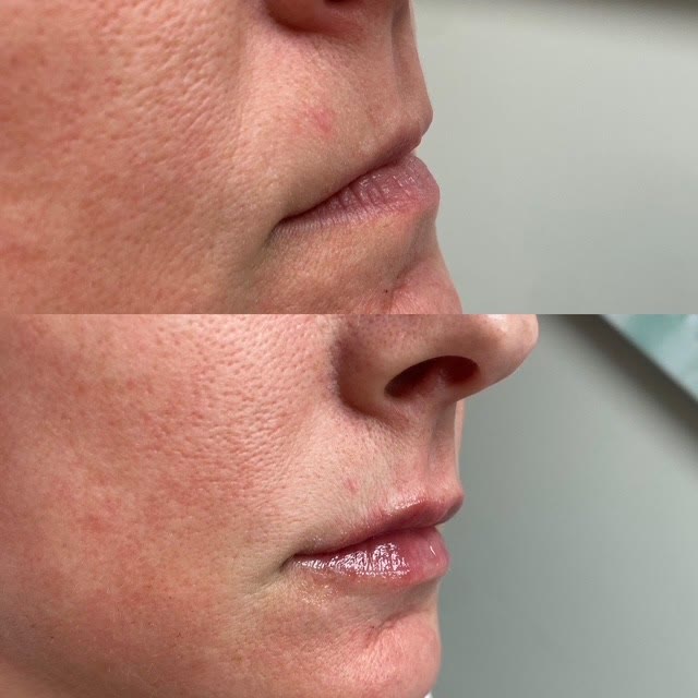 Before and after lip augmentation shown in profile.