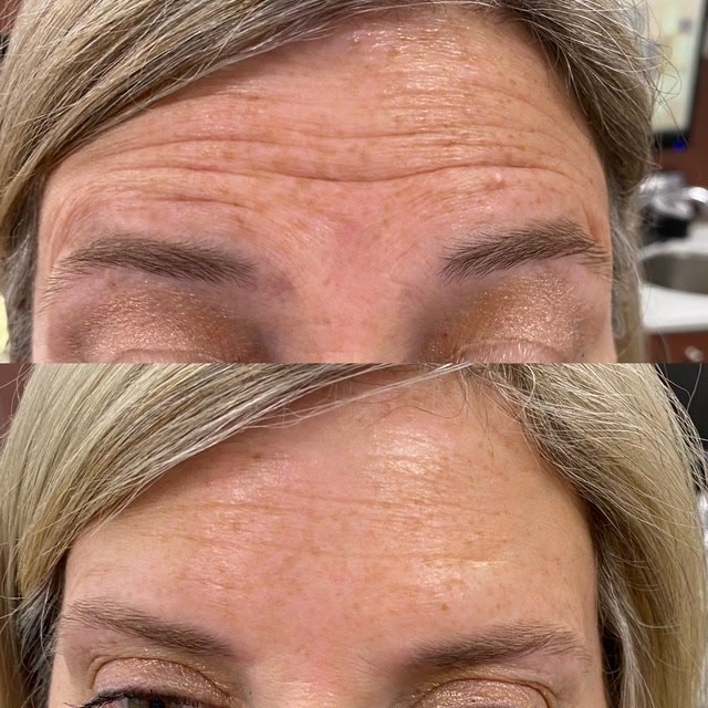 Forehead with wrinkles before treatment and smoother after treatment.