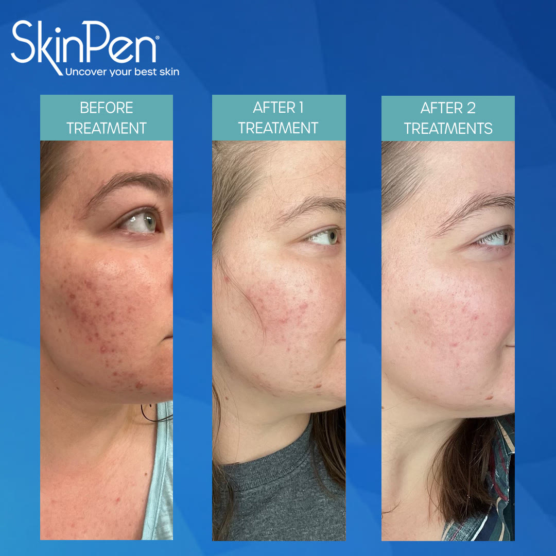SkinPen treatment results shown before treatment, after one treatment and after two treatments — visible reduction in scarring.